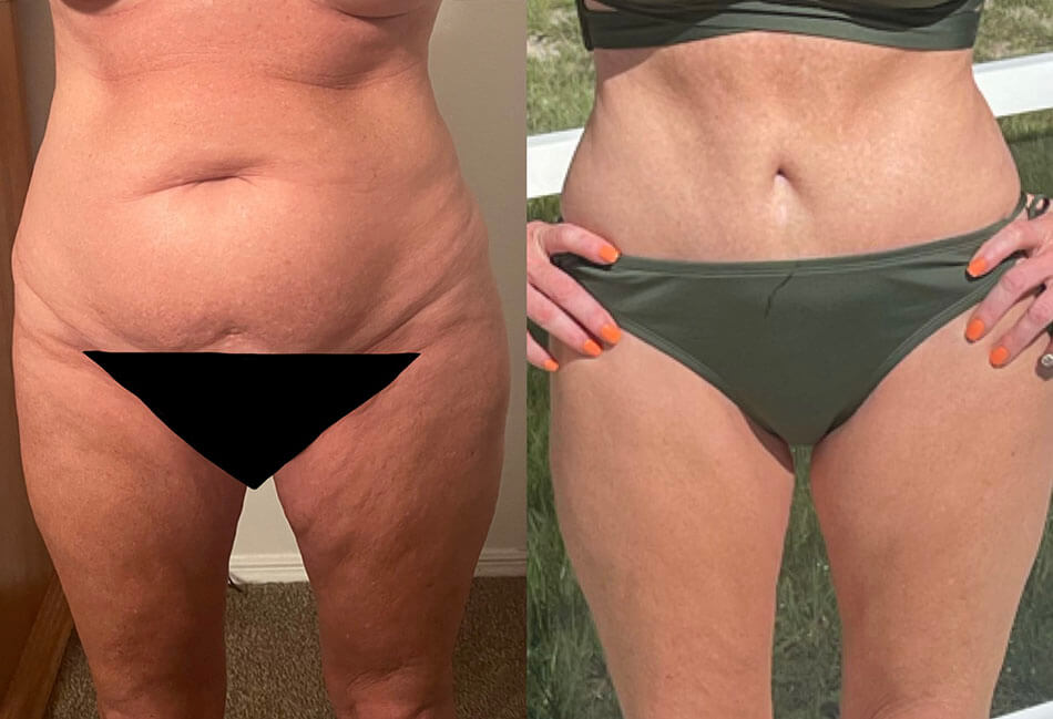 Abdominoplasty Patient