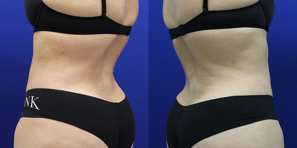 Awake Liposuction Patient 1 Back View