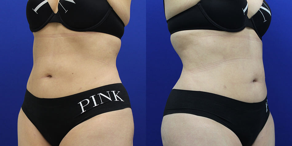 Awake Liposuction Patient 1 Side View