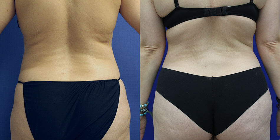 Awake Liposuction Patient 1 Back View