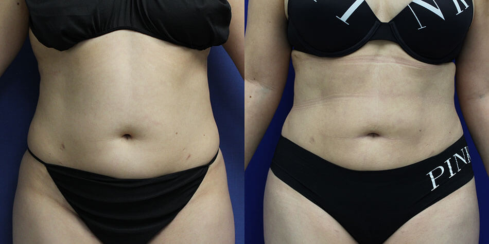 Awake Liposuction Patient 1 Front View