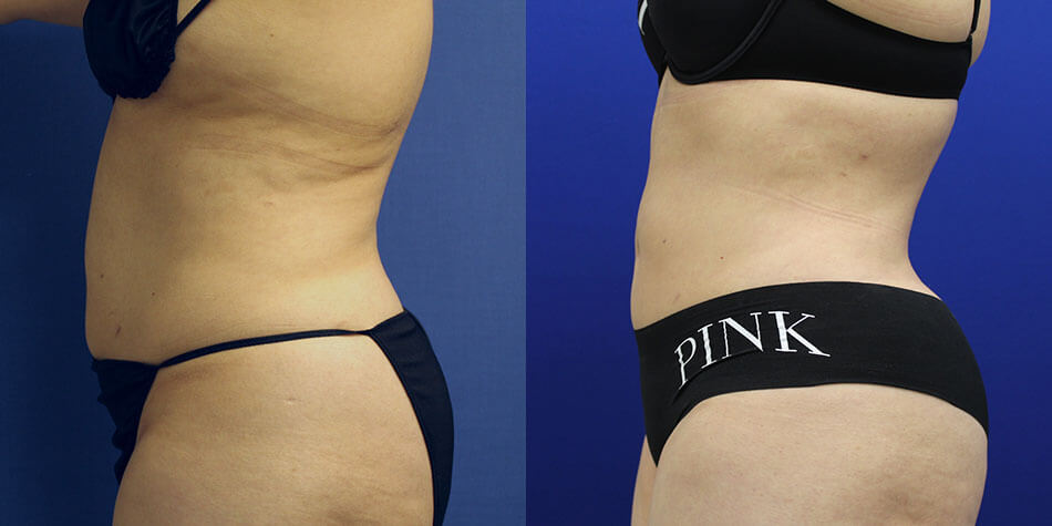 Awake Liposuction Patient 1 Side View