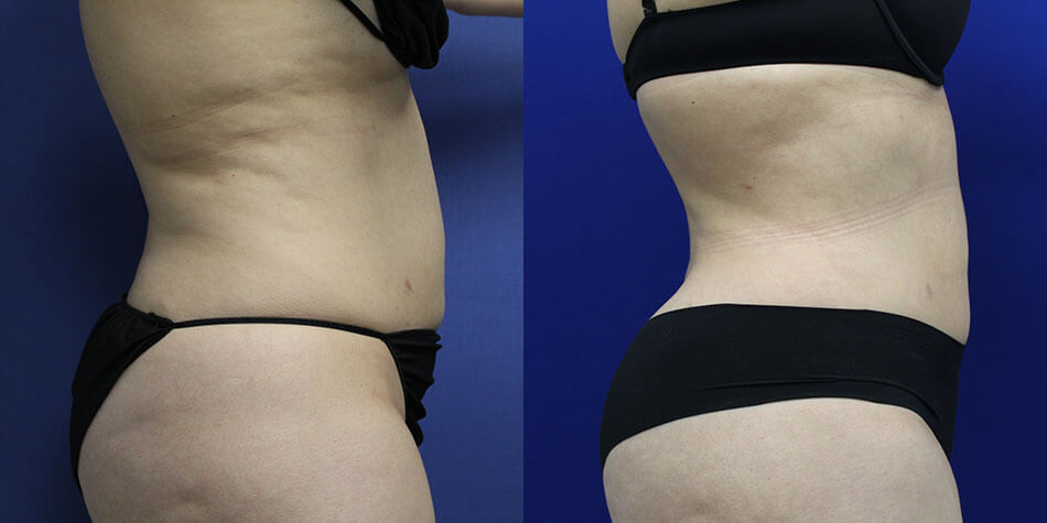 Awake Liposuction Patient 1 Side View