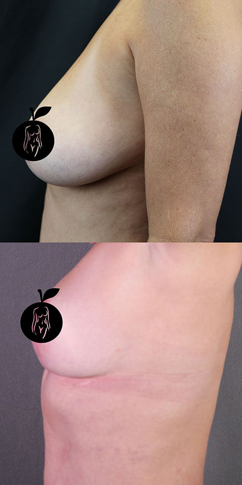 Breast Lift Patient 1 Side View