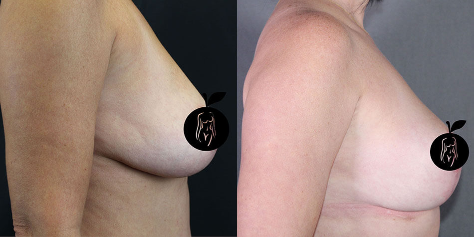 Breast Lift Patient 1 Side View