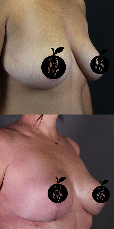Breast Lift Patient 1 Side View