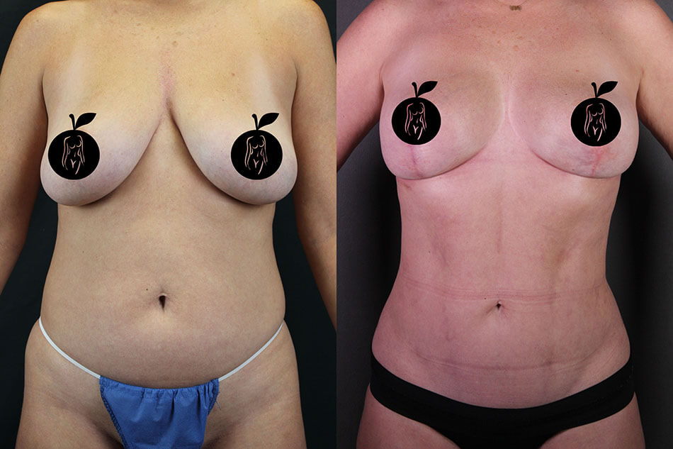 Breast Lift Patient 2 Front View