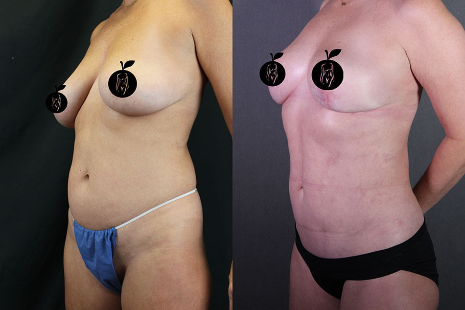 Breast Lift Patient 2 Side View