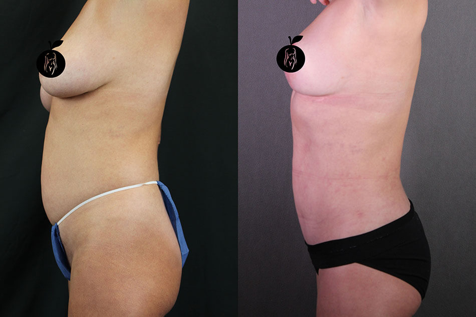 Breast Lift Patient 2 Side View