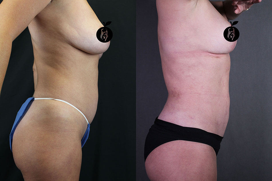 Breast Lift Patient 2 Side View