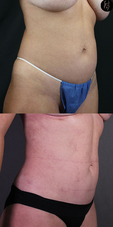 Liposuction Patient 1 Side View