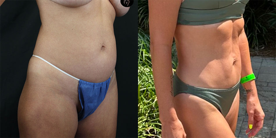 Liposuction Patient 2 Side View