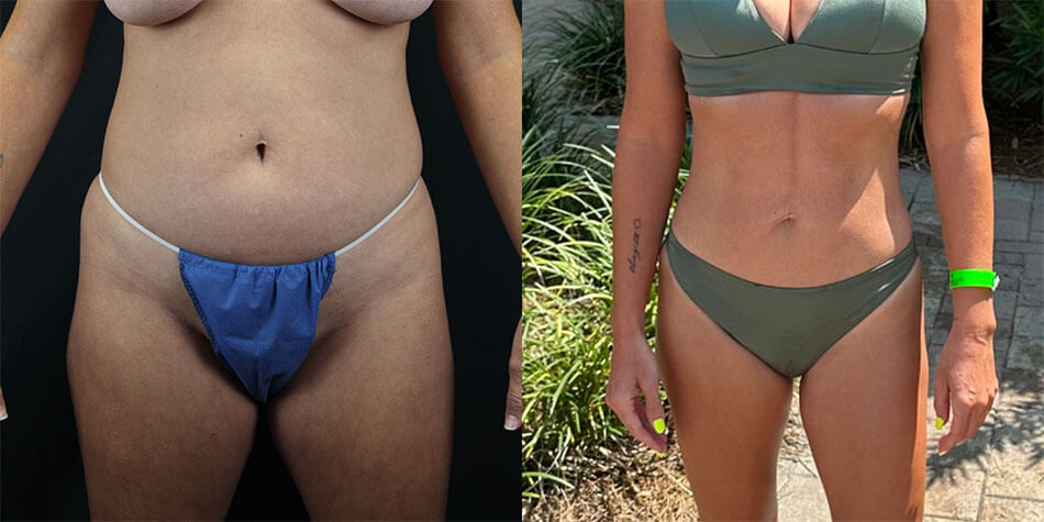 Liposuction Patient 2 Front View