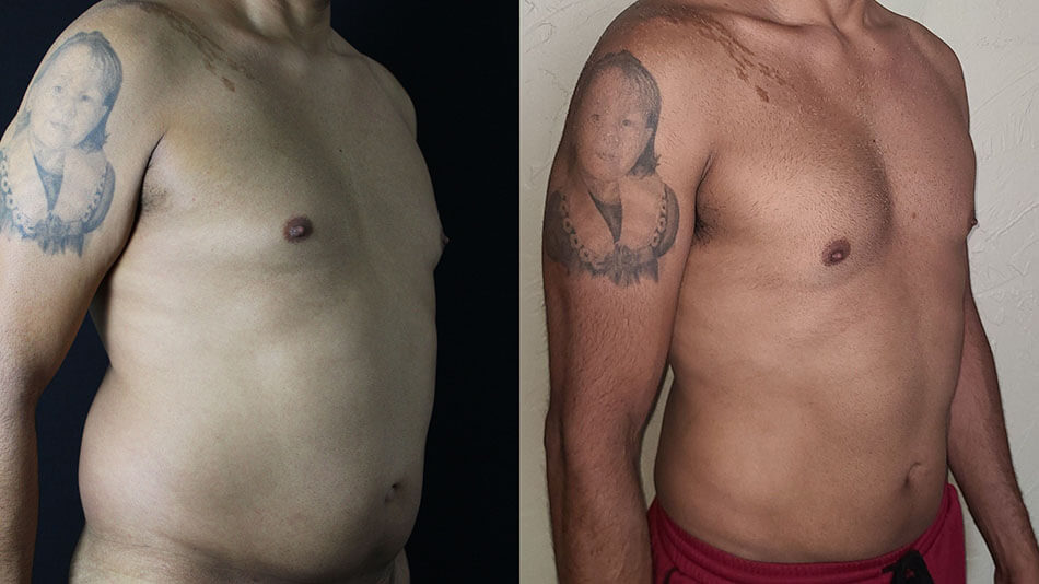 Liposuction Patient 3 Angle View