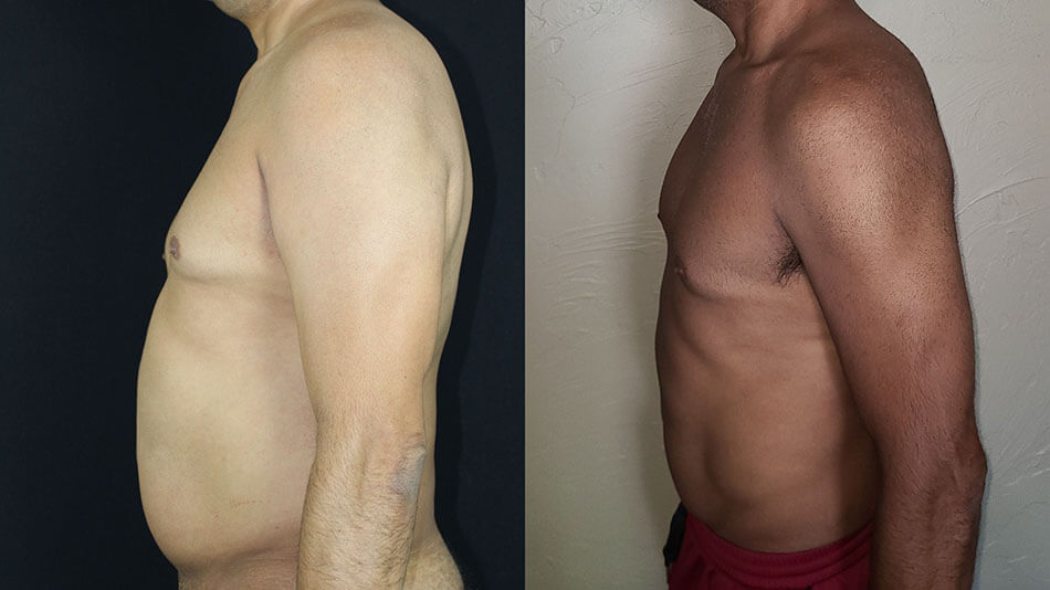 Liposuction Patient 3 Side View