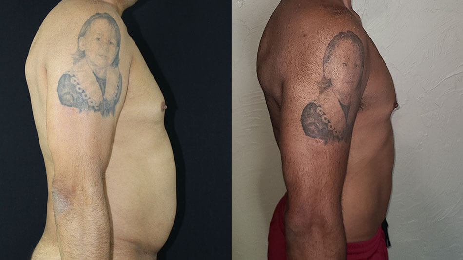 Liposuction Patient 3 Side View