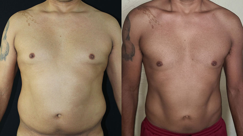 Liposuction Patient 3 Front View