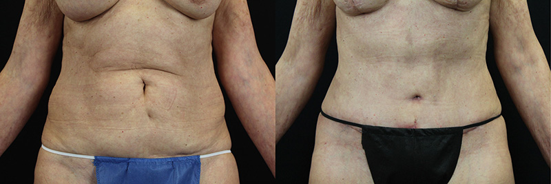 Tummy Tuck before and after 1