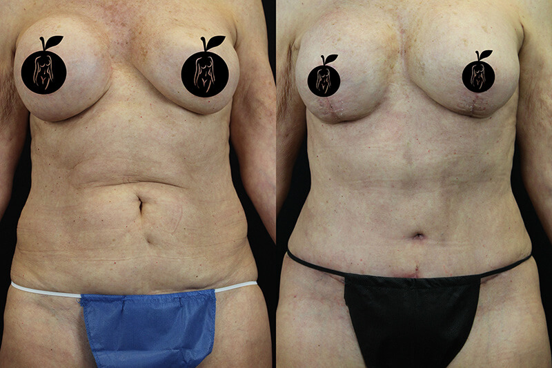 Tummy Tuck Patient 2 Results