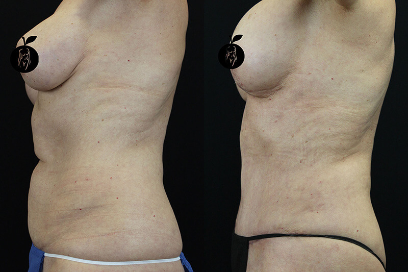 Tummy Tuck Patient 2 Results 3