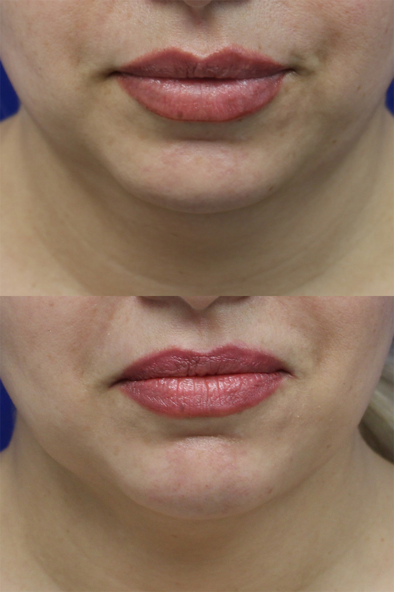 Chin Fillers Patient Results 2