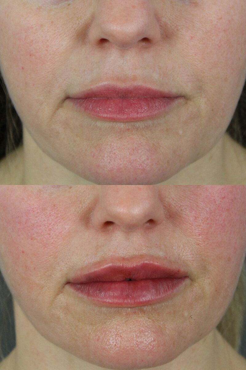 Lip Filler Patient 3 Results