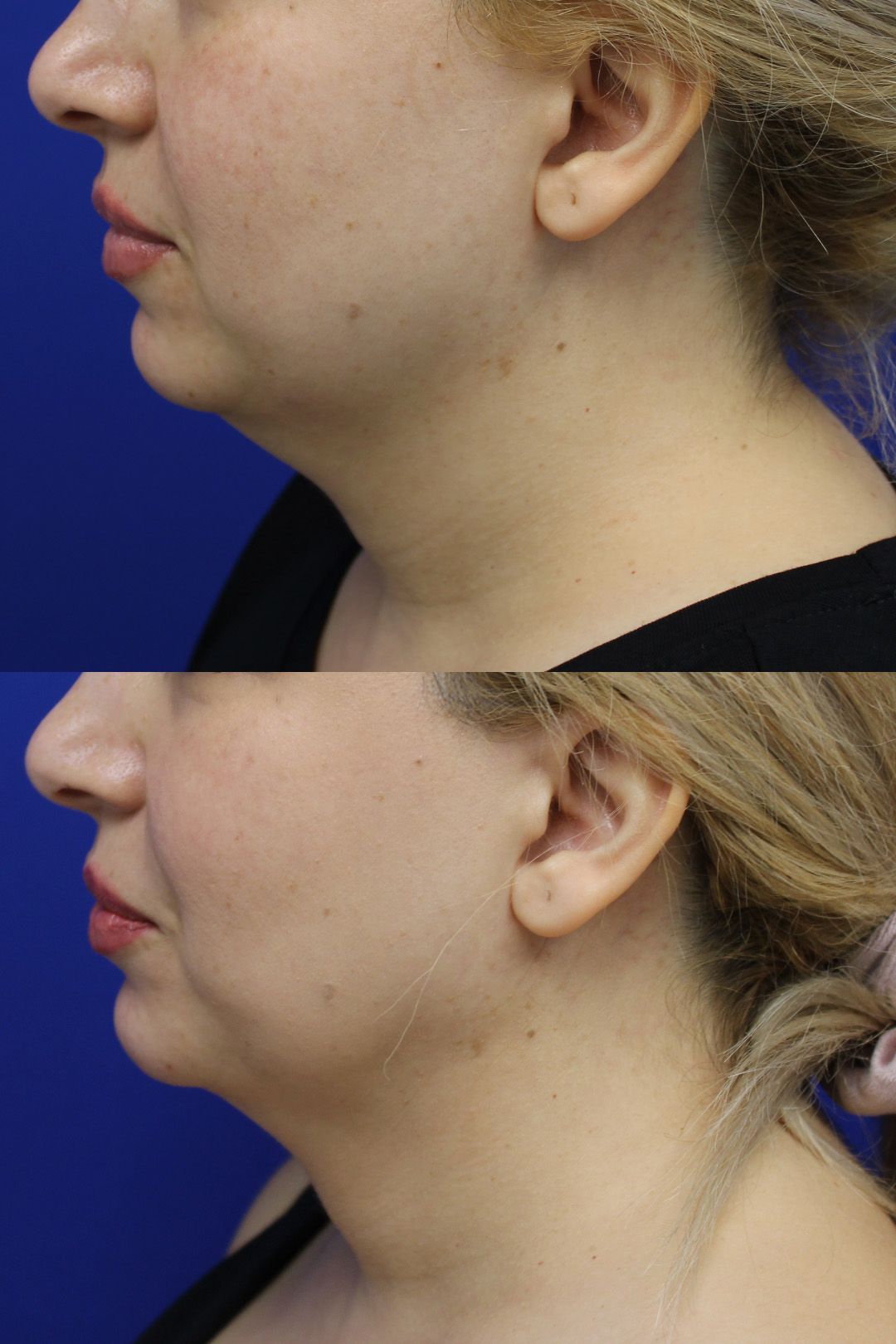 Liposuction Patient Results