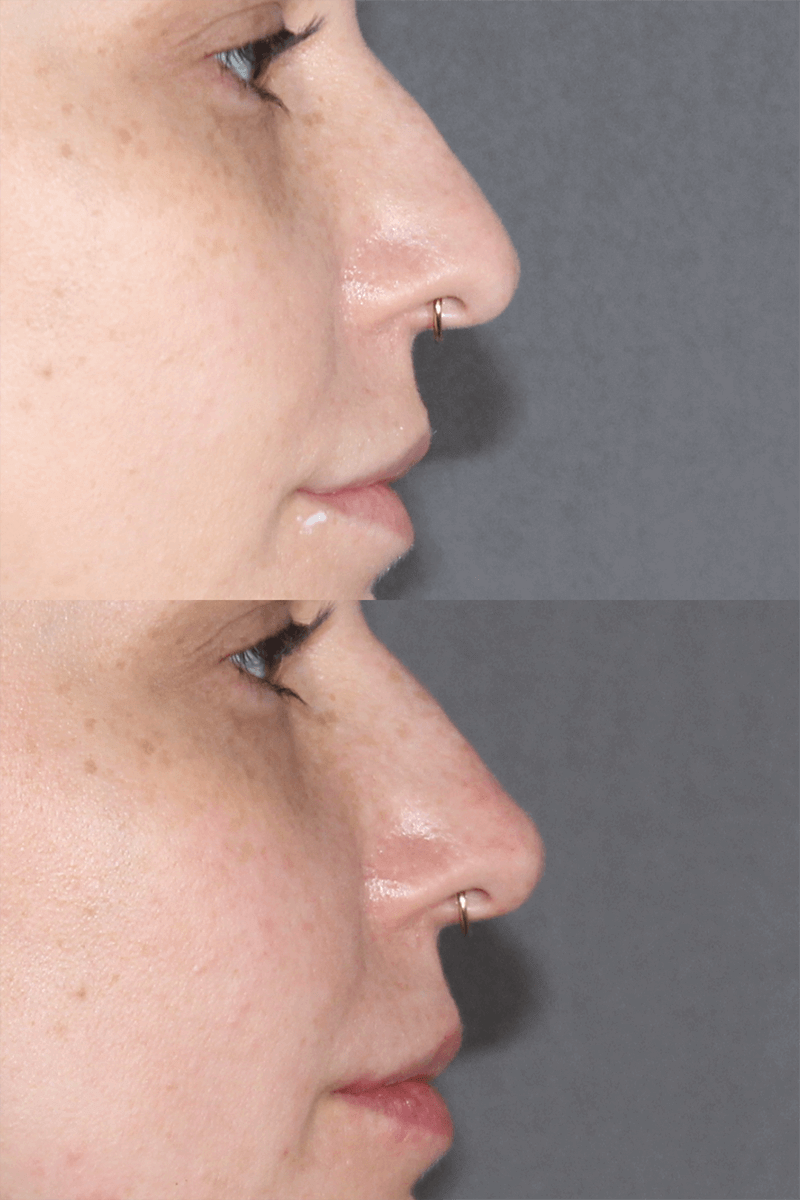 Liquid Rhinoplasty Patient Results 2