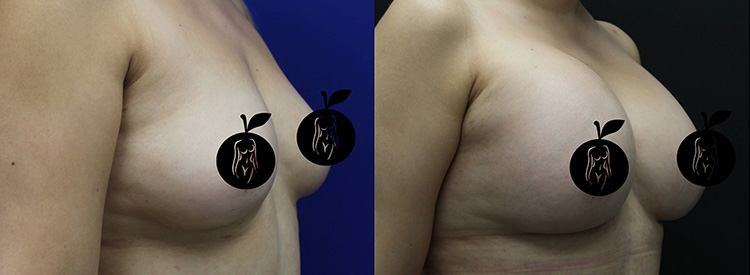 Breast Aug Before and After 3